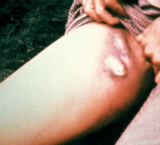 Swollen Plague Bubos on the Leg